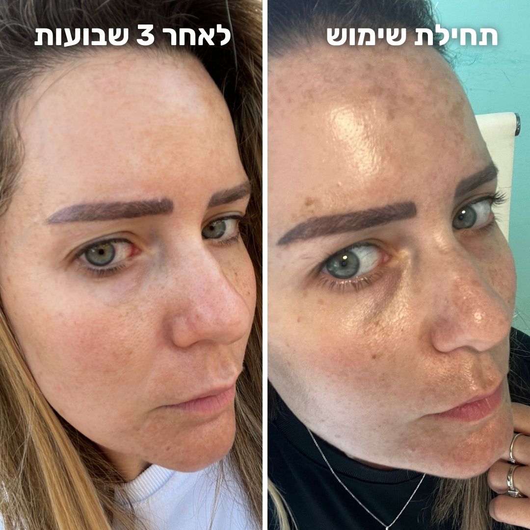 ⁦קרם קלריטי טיפול באקנה והבהרה⁩ – תמונה ⁦4⁩